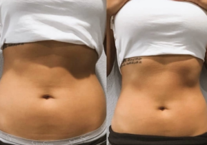 pcdc fat dissolving injections abdomen results